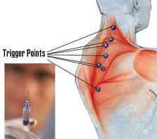 What is a Trigger Point? — Indy Spine and Rehab